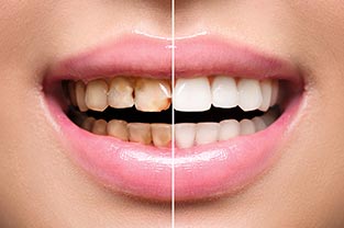 Restore your Dental Health and Appearance with a Complete Smile Makeover