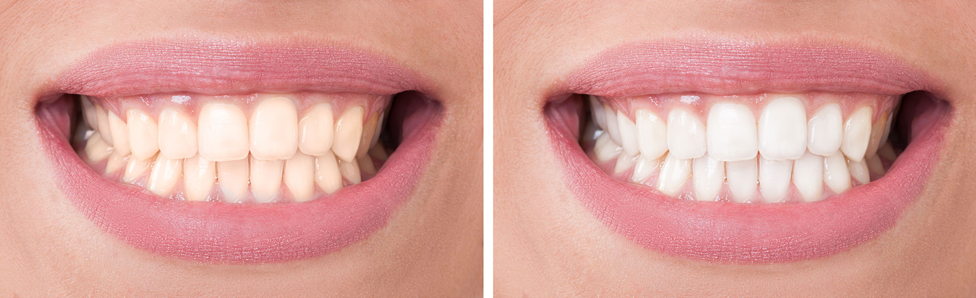 Teeth Whitening Treatments Teeth Whitening in Houston, TX