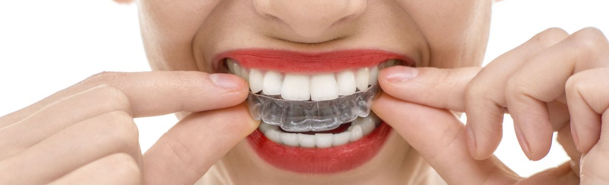 What Are The Pros and Cons Of Clear Braces
