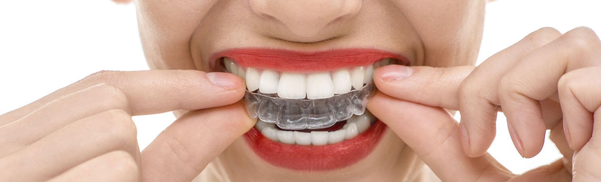 The Pros and Cons of Clear Braces