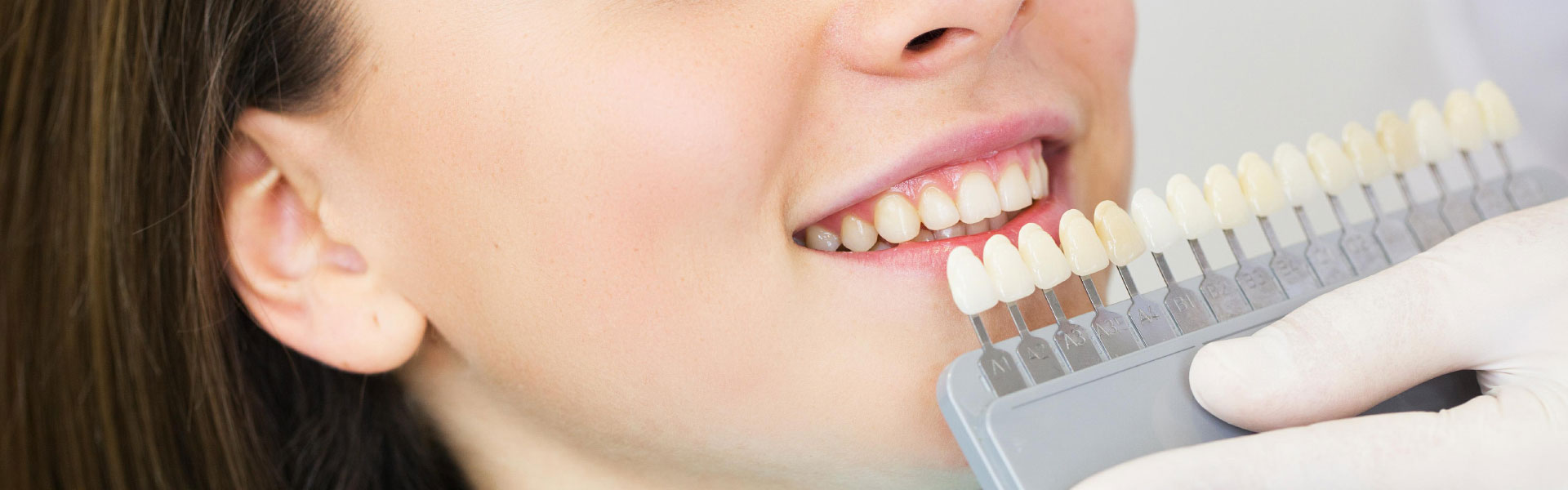 What You Should Know about Porcelain Veneers