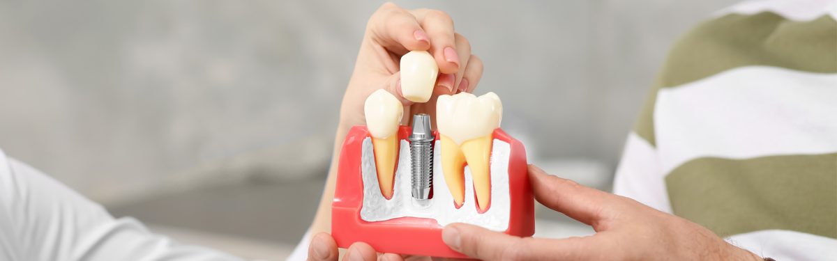 _What Are Full Mouth Dental Implants