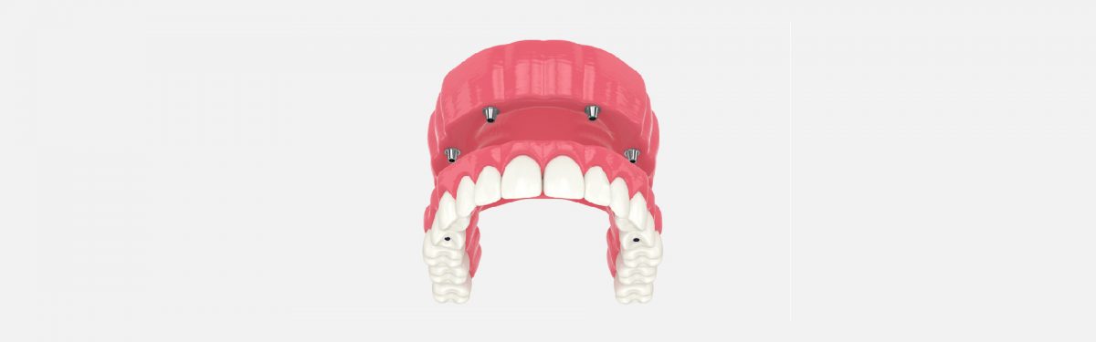 Maintaining Oral Hygiene with All-on-4 Dental Implants