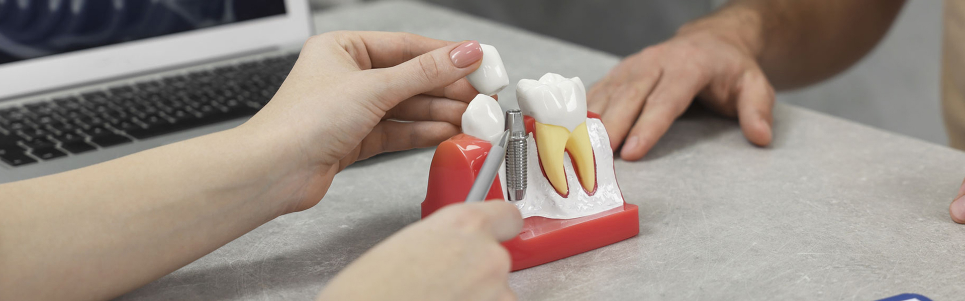 How Dental Implants Help Jawbone Health